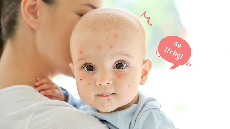 ابتلا به آبله میمون